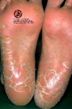 Ichthyosis Feet photo from Univ. Erlagen, Dept. of Dermatology (+49) 9131-85-2727