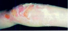Burn Photo 1 - Emu Oil