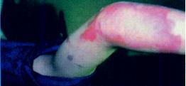 Burn Photo 2 - Emu Oil