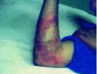 Burn Photo 3 - Emu Oil