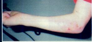 Burn Photo 4 - Emu Oil