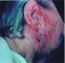 Eczema Photo 1 - Emu Oil