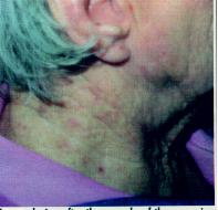 Eczema Photo 3 - Emu Oil