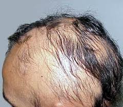 Emu oil for hair loss