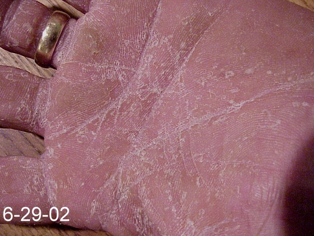 Hand with Skin Fungus before using Emu Oil