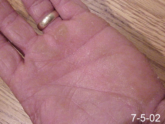 Hand of Skin Fungus after using Emu Oil for 6 days.