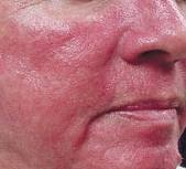 rosacea photo 1