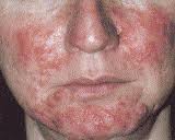 rosacea photo2