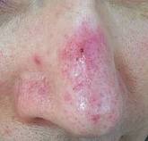 rosacea photo 3
